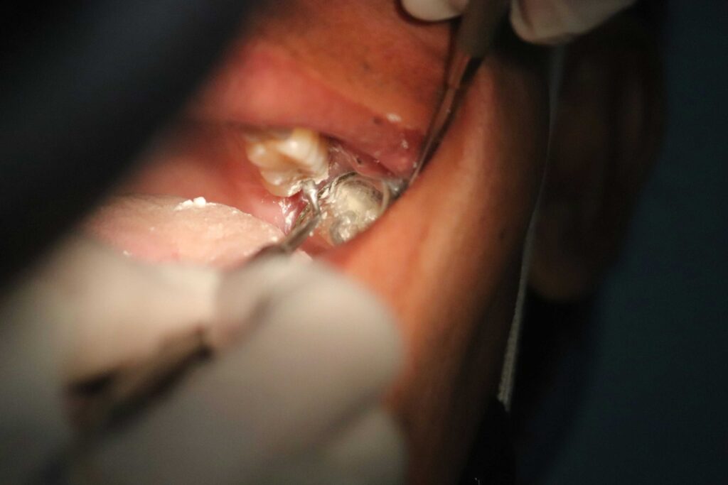 A person receiving a dental cleaning with a toothbrush, highlighting the importance of oral hygiene for implant-supported dentures.