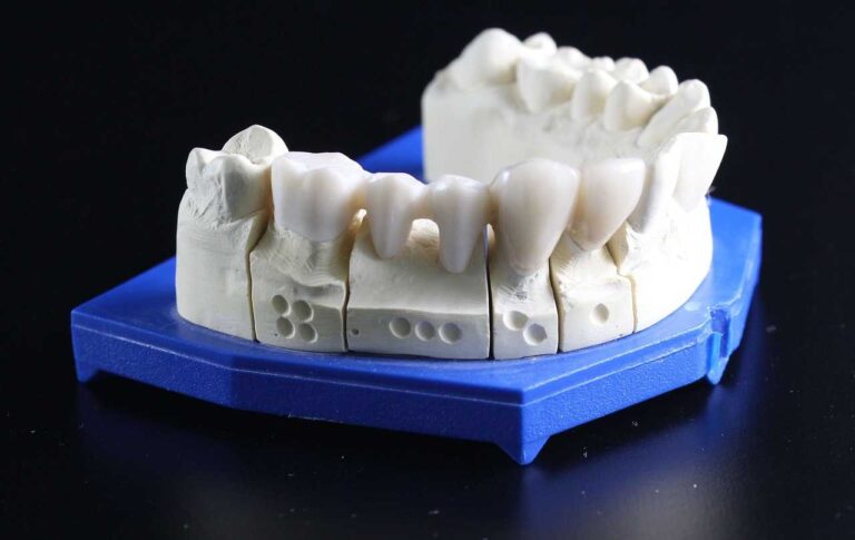 A tooth model featuring a denture highlighting the importance of dental prosthetics in oral health