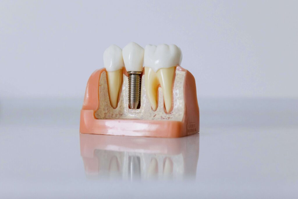 A close-up view of a tooth model showcasing a dental implant, highlighting its role in restorative dentistry.